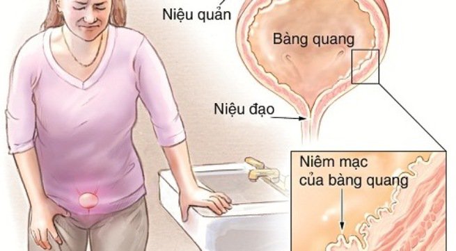 Bí tiểu do bàng quang kém hoạt động